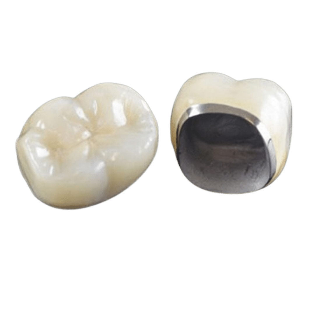 Metal Porcelan 100€