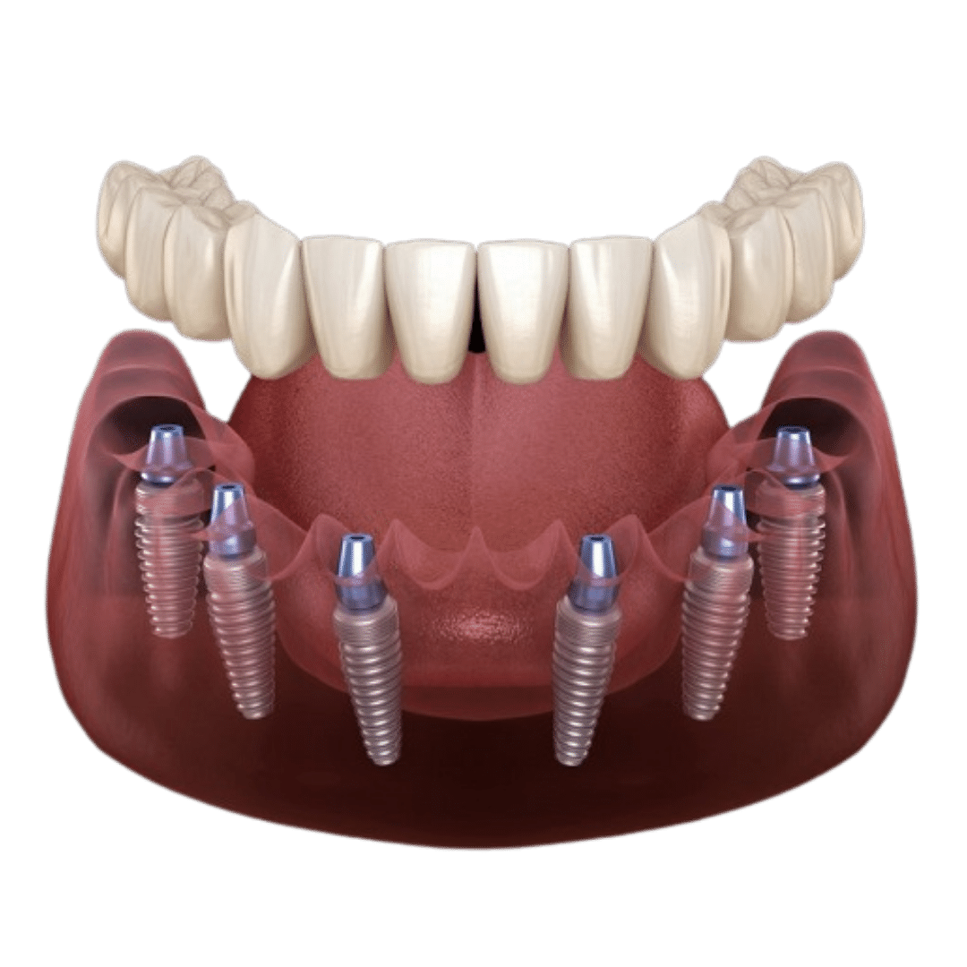 All on 6 implantology 4500 €