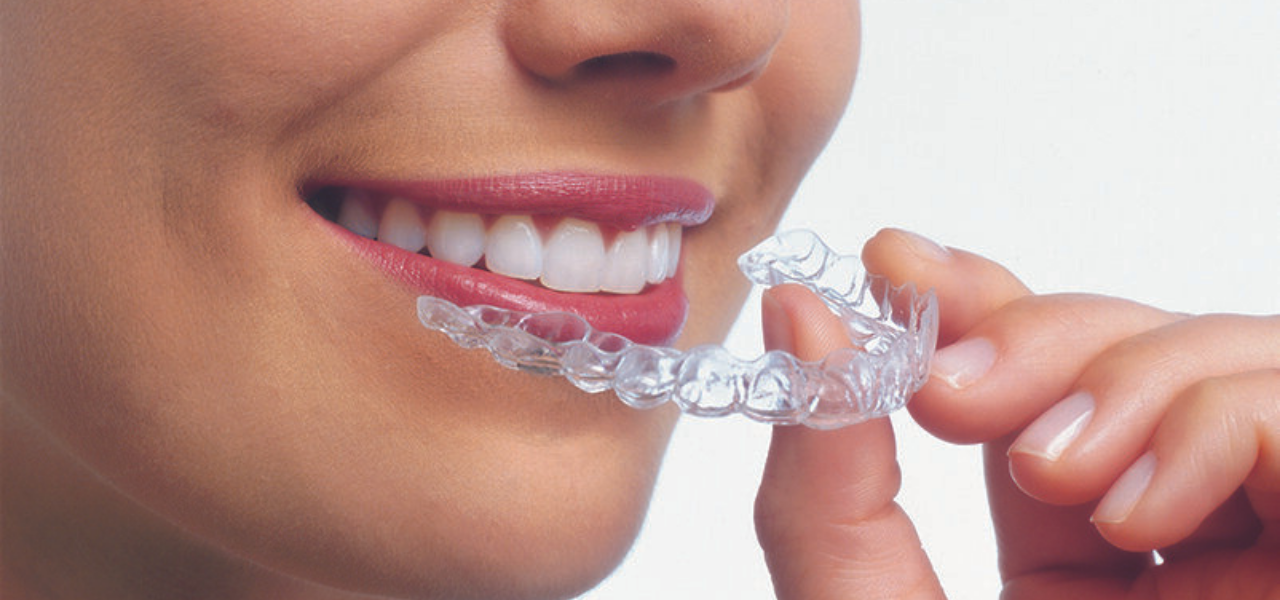 Invisalign Aligners in Albania
