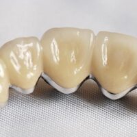 Dental Crowns in albania