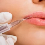 dermal-fillers-for-the-lips dermal fillers in albania